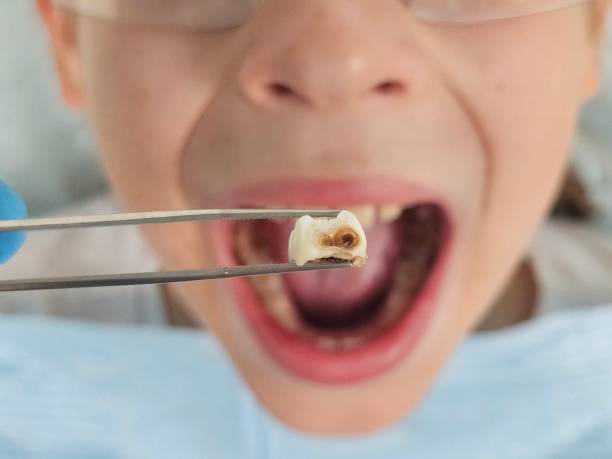 Best Emergency Root Canal Treatment in Cornersville, TN